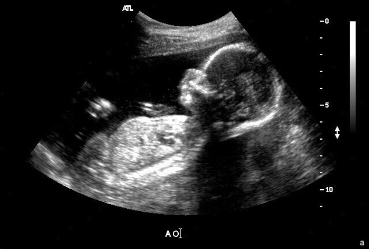 Конец 18 недели. Малыш на 22 неделе беременности УЗИ. Плод на 22 неделе беременности фото УЗИ. УЗИ ребенка на 31 неделе беременности.